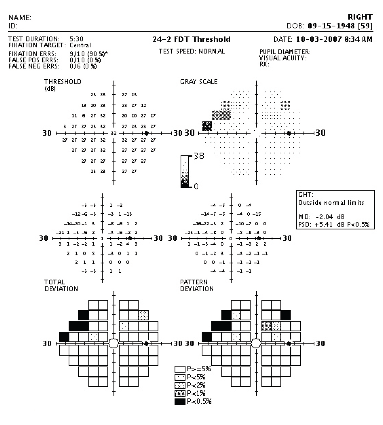 glaucoma-risk-factors-distinguishable-with-visual-field-test-combo